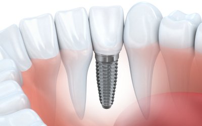 Dental Implants: How They Work