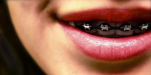 Smile with Braces