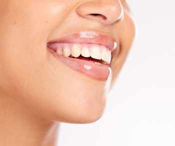 Teeth Whitening by Cosmetic Dentist in Rochester