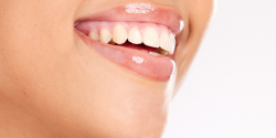 teeth whitening - part of cosmetic dentistry in Rochester