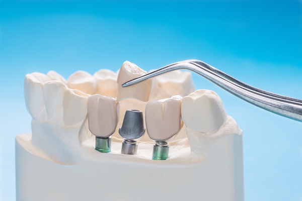 Tips For Implant Crown Care